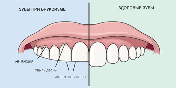 Hammaste krigistamine: terved hambad ja hambad ajal bruxism