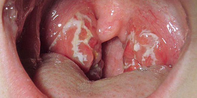 sümptomid tonsilliit