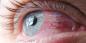 Konjunktiviit: miks punastama silmad ja kuidas neid ravida