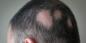 Alopeetsia: miks kaotate juukseid ja kuidas neid ravida