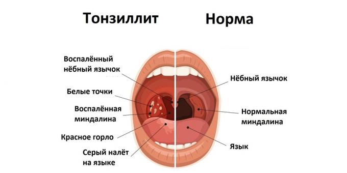 Tonsilliit ja normaalne seisund 
