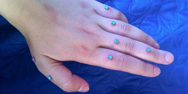Transdermaalne implantaadi sõrmed