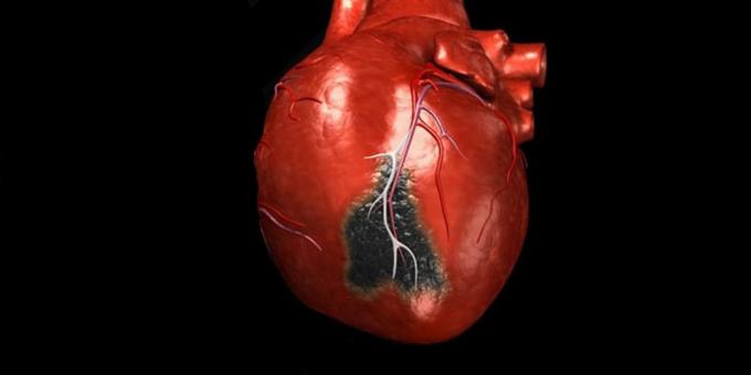 Sümptomid südameinfarkti, mille jaoks sul on vaja helistada kiirabi