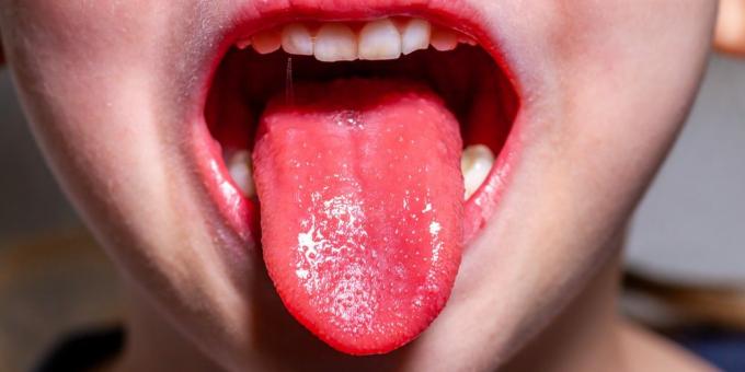Scarlet palaviku sümptomid: maasika keel