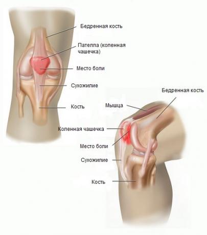 patellofemoral valusündroom