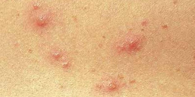 Sümptomid tuulerõuged lastel ja täiskasvanutel: Üsna sageli, naha koheselt ilmuvad väikesed punased täpid